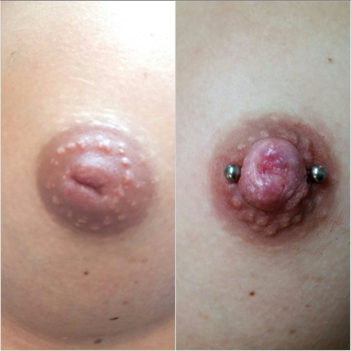 Vorher/Nachher-Beispiel Schlupfwarzenkorrektur durch Piercing, Beispiel 7