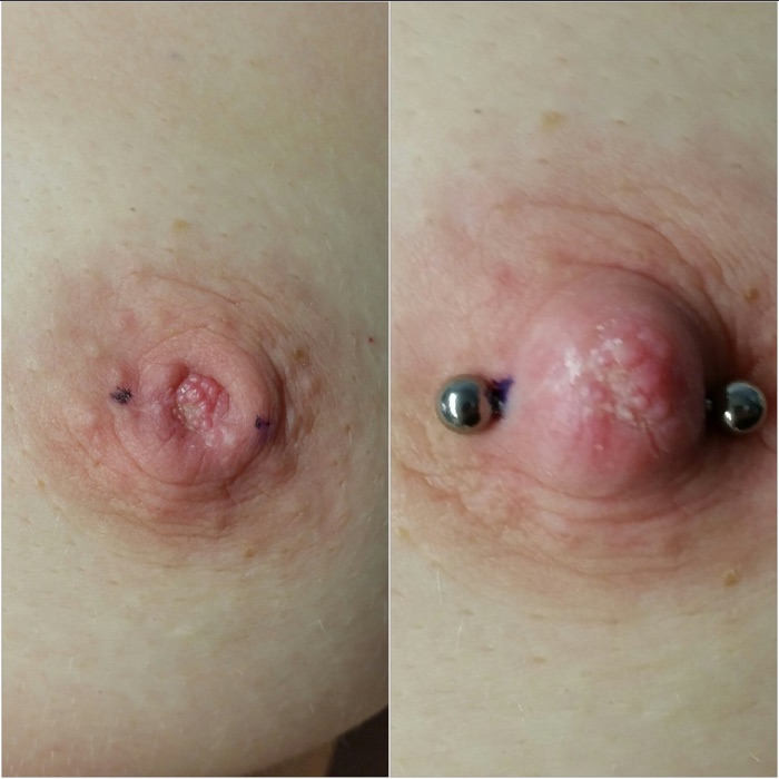 Vorher/Nachher-Beispiel Schlupfwarzenkorrektur durch Piercing, Beispiel 12