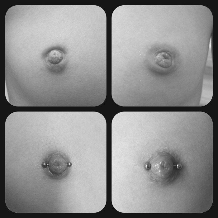 Vorher/Nachher-Beispiel Schlupfwarzenkorrektur durch Piercing, Beispiel 19