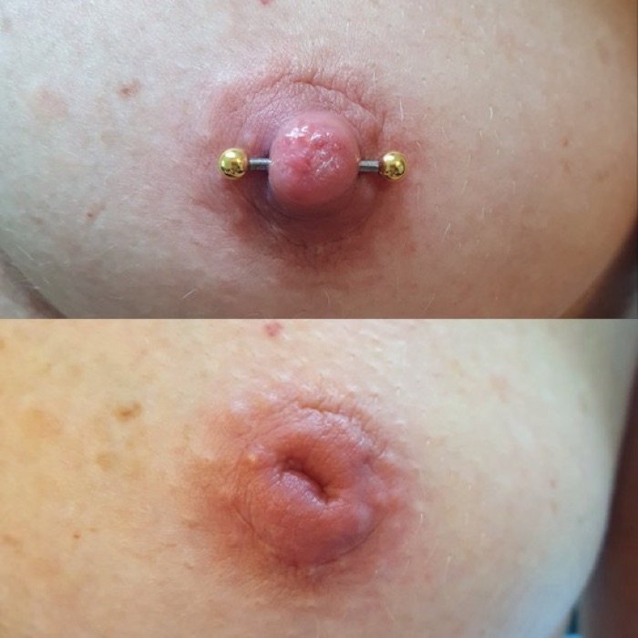 Vorher/Nachher-Beispiel Schlupfwarzenkorrektur durch Piercing, Beispiel 23