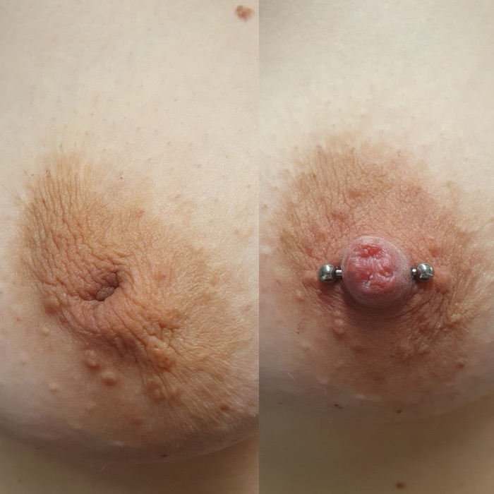 Vorher/Nachher-Beispiel Schlupfwarzenkorrektur durch Piercing, Beispiel 27